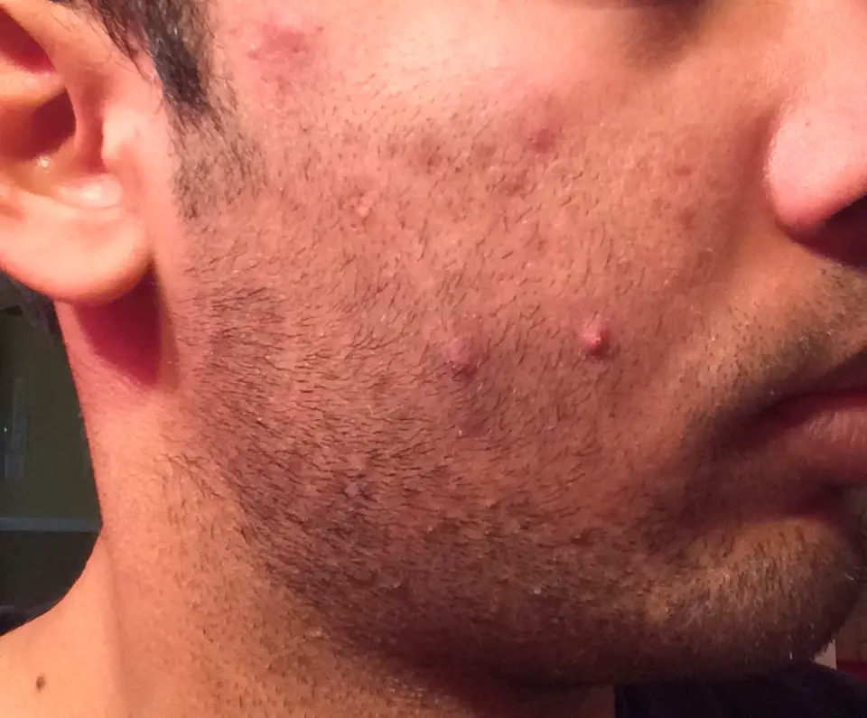 beard acne