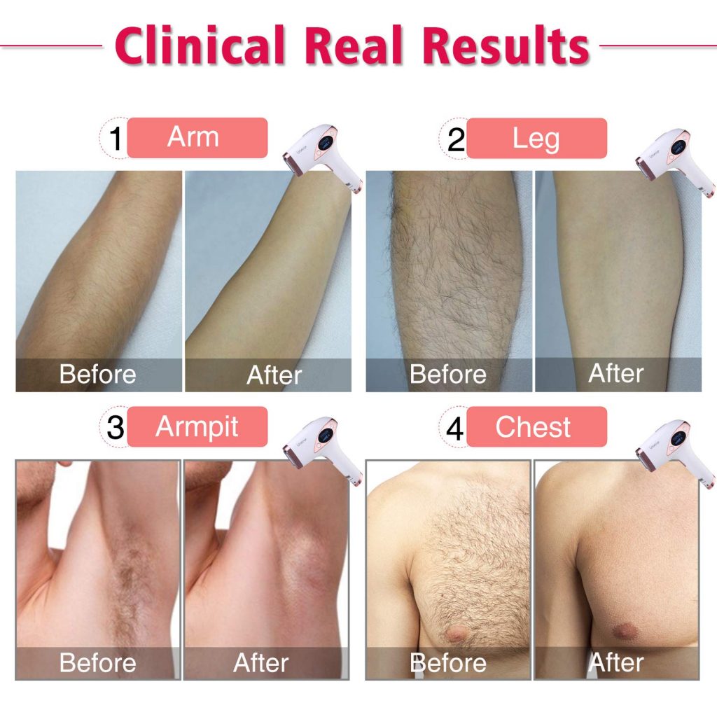 laser hair removal machines for sensitive skin