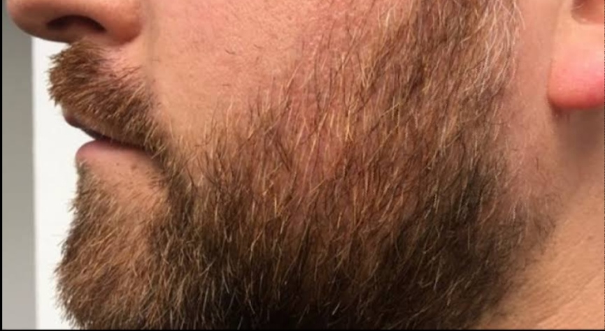 home remedies for beard oil,  how to grow beard,  how to grow a beard faster at 18,  home remedies for beard care,  beard growing tips,  how to grow beard on cheeks, 